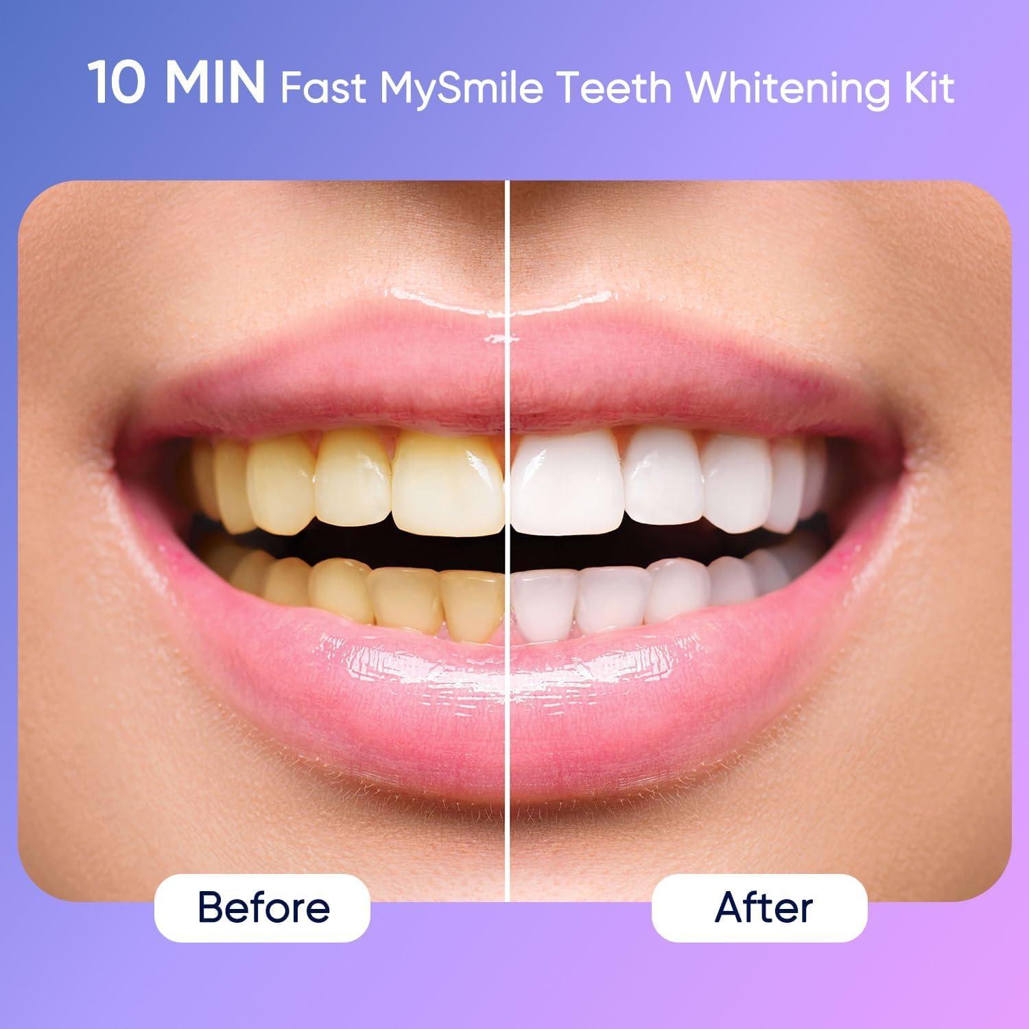 image:imageMySmile Deluxe 10 Min Teeth Whitening Kit with 28 LED Light 35 Carbamide Peroxide Teeth Whitening Gel Helps Remove Years of Stains from Coffee Soda Wines Smoking Food16 Fl Oz Pack of 1