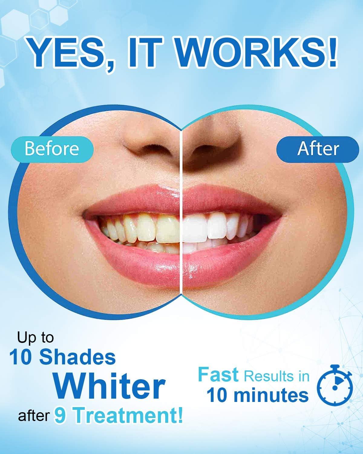 image:imageMySmile Teeth Whitening Accelerator Light 28 LED Blue Light Each 10 Minutes USB Charger Mouth Trays 1 Pcs LED Light amp 4ml GelDark Blue