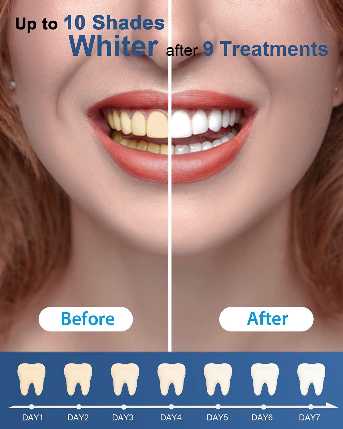 image:imageMySmile Teeth Whitening Gel Pen Refill Pack 3 NonSensitive Teeth Whitening Pen Deluxe Teeth Whitener Dental Grade Tooth Whitening Gel with Carbamide Peroxide for Home Fast ResultPack Of6