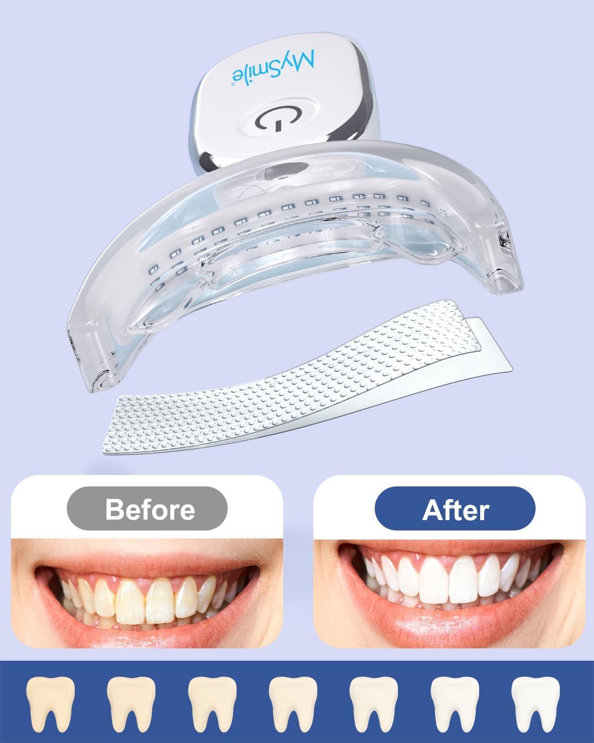 image:imageMySmile Teeth Whitening Pen 30 Treatment Enamel Safe Tooth Whitening Gel for Teeth Sensitive10 Min Fast Whitening TeethHelps to Remove Stains from Coffee Smoking WinesMint Flavor28 Fl Oz Pack of 1